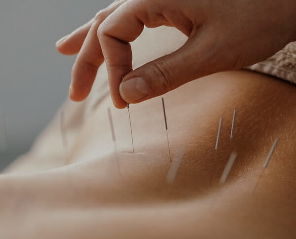 service acupuncture