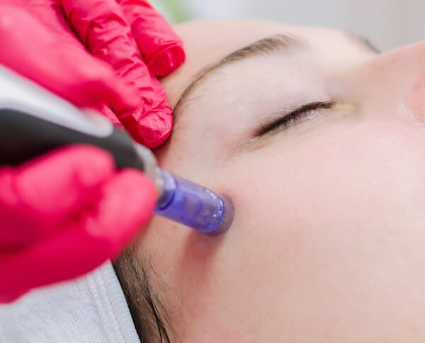 service_microneedling-2